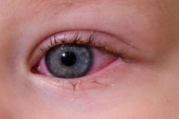 фото аллергического конъюнктивита у ребенка